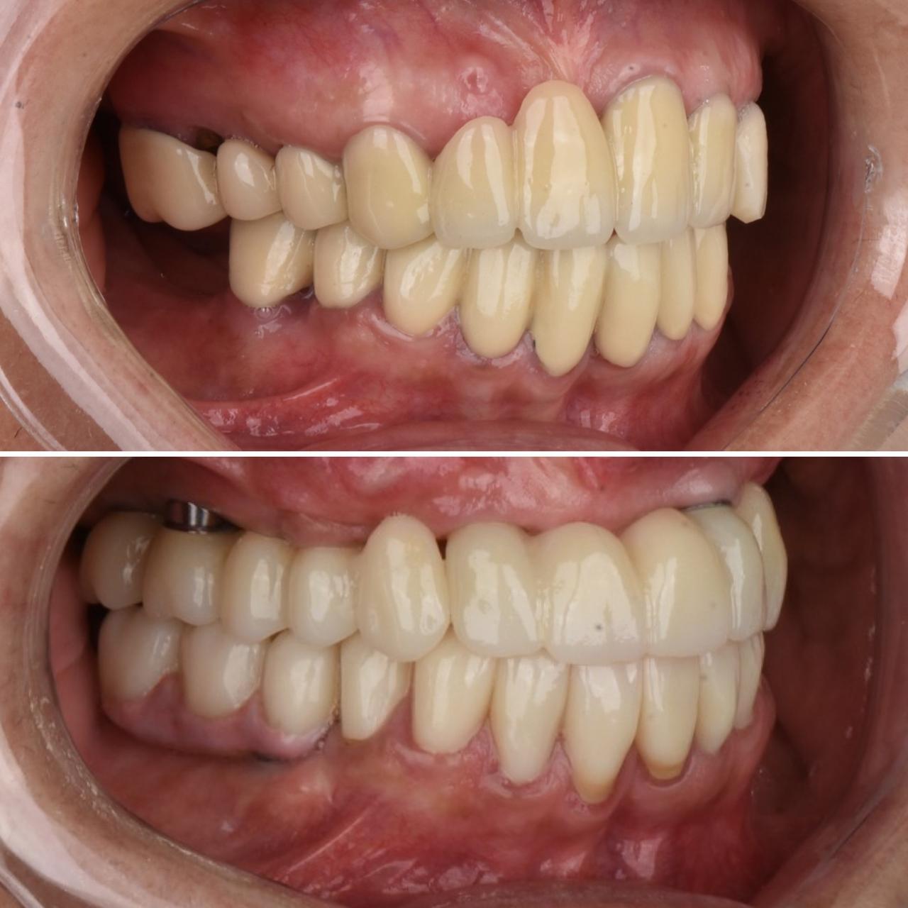 Carillas e.max y coronas estéticas — Protdent